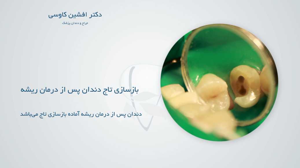 باز سازی تاج دندان پس درمان ریشه - وبسایت دکتر افشین کاوسی