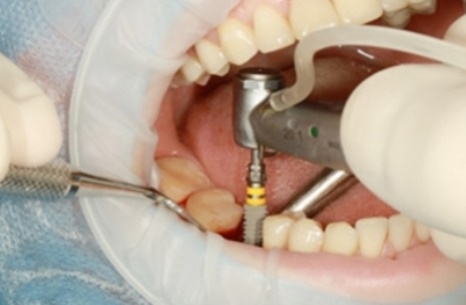 ایمپلنت های دندانی - وبسایت دکتر افشین کاوسی