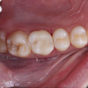 ترمیمهای کامپوزیتی همرنگ دندان-دکتر افشین کاوسی