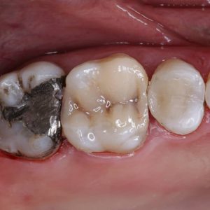 ترمیمهای کامپوزیتی همرنگ دندان-دکتر افشین کاوسی