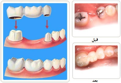 پروتزهای ثابت (روکش دندان) -وبسایت دکتر افشین کاوسی
