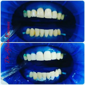 سفید کردن دندان (بلیچینگ) - از مقالات وبسایت دکتر افشین کاوسی