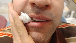 بایدها و نبایدهای پس از کشیدن دندان و جراحی ها-نحوه نگهداری گاز بر روی دندانها-از وبسایت دندانپزشکی دکتر افشین کاوسی