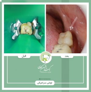 ترمیم های همرنگ دندان ترمیم های همرنگ دندان -وبسایت دکتر افشین کاوسی