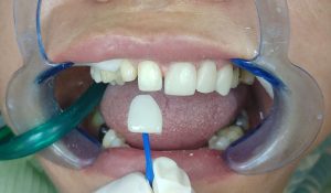 مقایسه انواع روشهای زیبایی دندان - مقالات وبسایت دکتر افشین کاوسی
