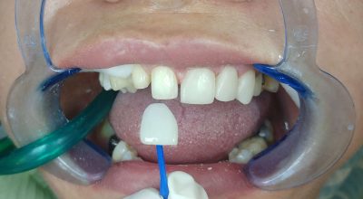مقایسه انواع روشهای زیبایی دندان