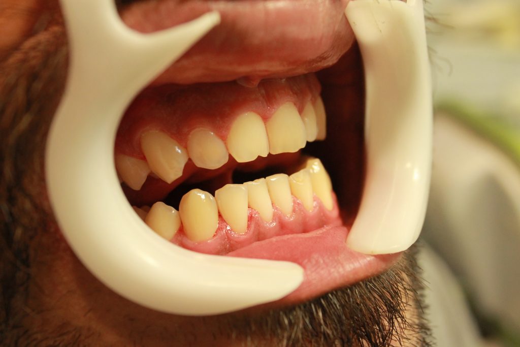 چرا جرمگیری دندانها لازم است؟ - از مقالات وبسایت دکتر افشین کاوسی، جراح و دندانپزشک