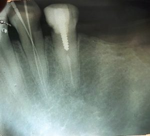دندانپزشکی وتکنولوژی قسمت اول اپکس فایندرها-مقالات وبسایت دکتر افشین کاوسی