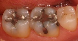 آمالگام و کاربرد آن در دندانپزشکی-مقالات وبسایت دکتر افشین کاوسی