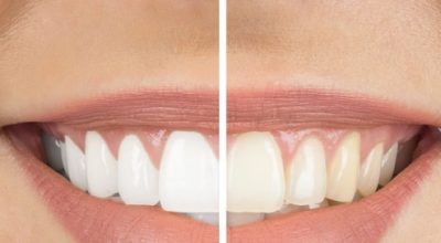 زیبایی دندان،از واقعیت تا توهم قسمت دوم-مقالات وبسایت دکتر افشین کاوسی