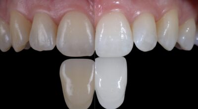 سفید کردن دندان -وب سایت دکتر افشین کاوسی