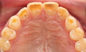 دندان قروچه ، راههای کنترل و درمان
