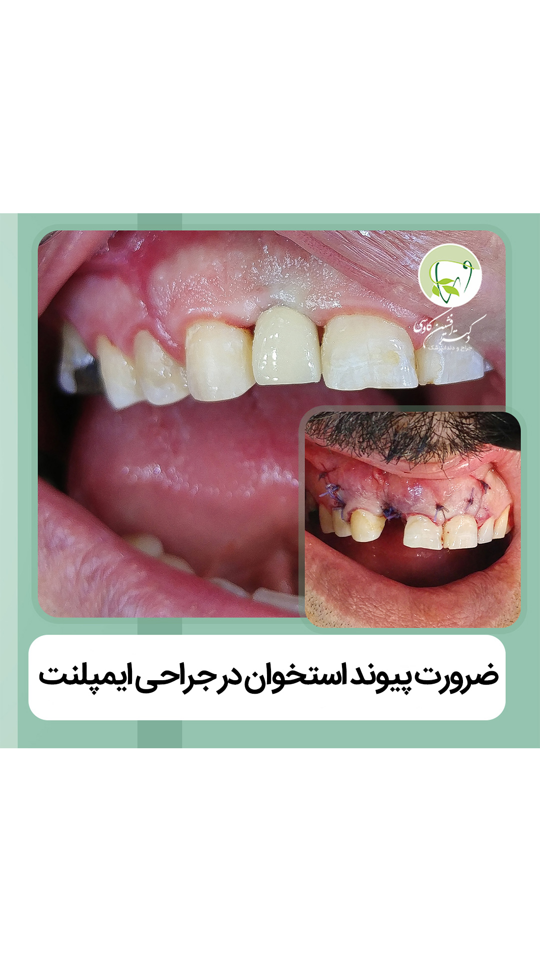 ضرورت پیوند استخوان در جراحی ایمپلنت