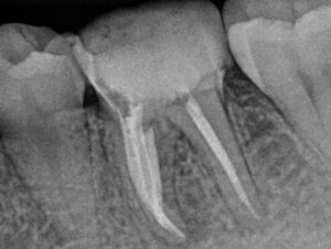 دندان آسیای واجد 5 کانال-مولر 5کاناله
