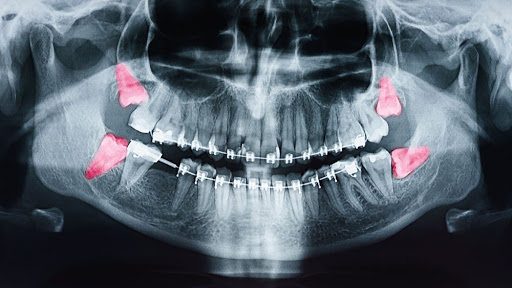 پرسش و پاسخهای رایج دندانپزشکی(1)