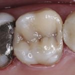 انواع ترمیم های همرنگ دندان