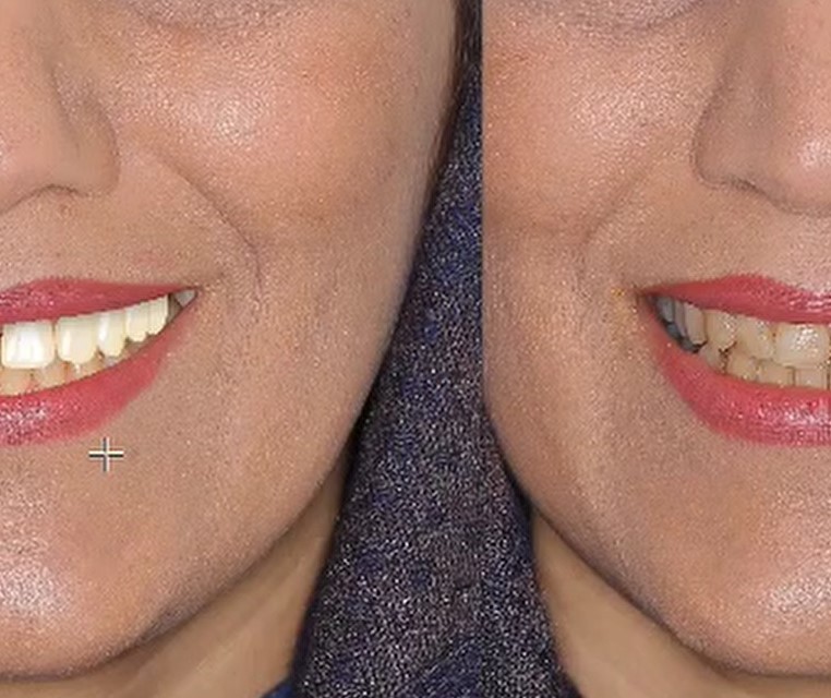 طراحی لبخند دیجیتالی چیست؟-گالری ویدیوی وبسایت دکتر افشین کاوسی