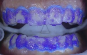 سفیدکردن دندان -دکتر افشین کاوسی