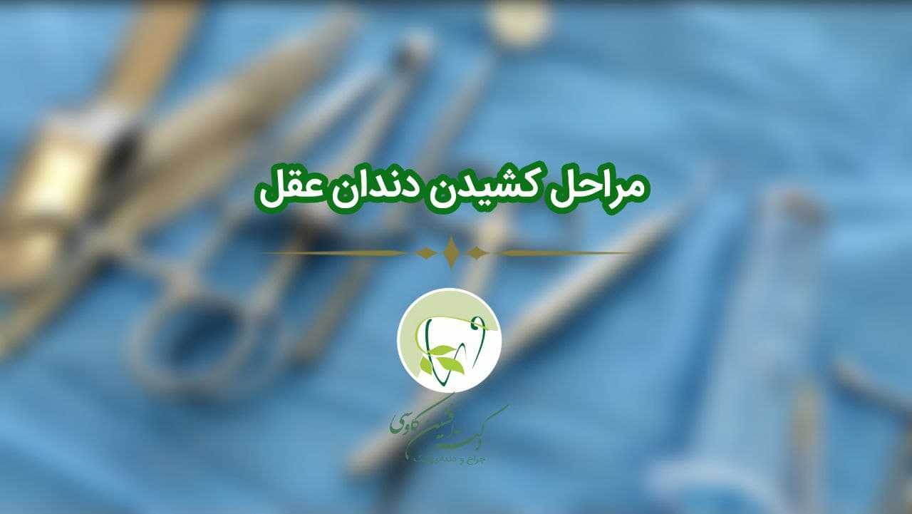 جراحی دندان عقل -وبسایت دکتر افین کاوسی