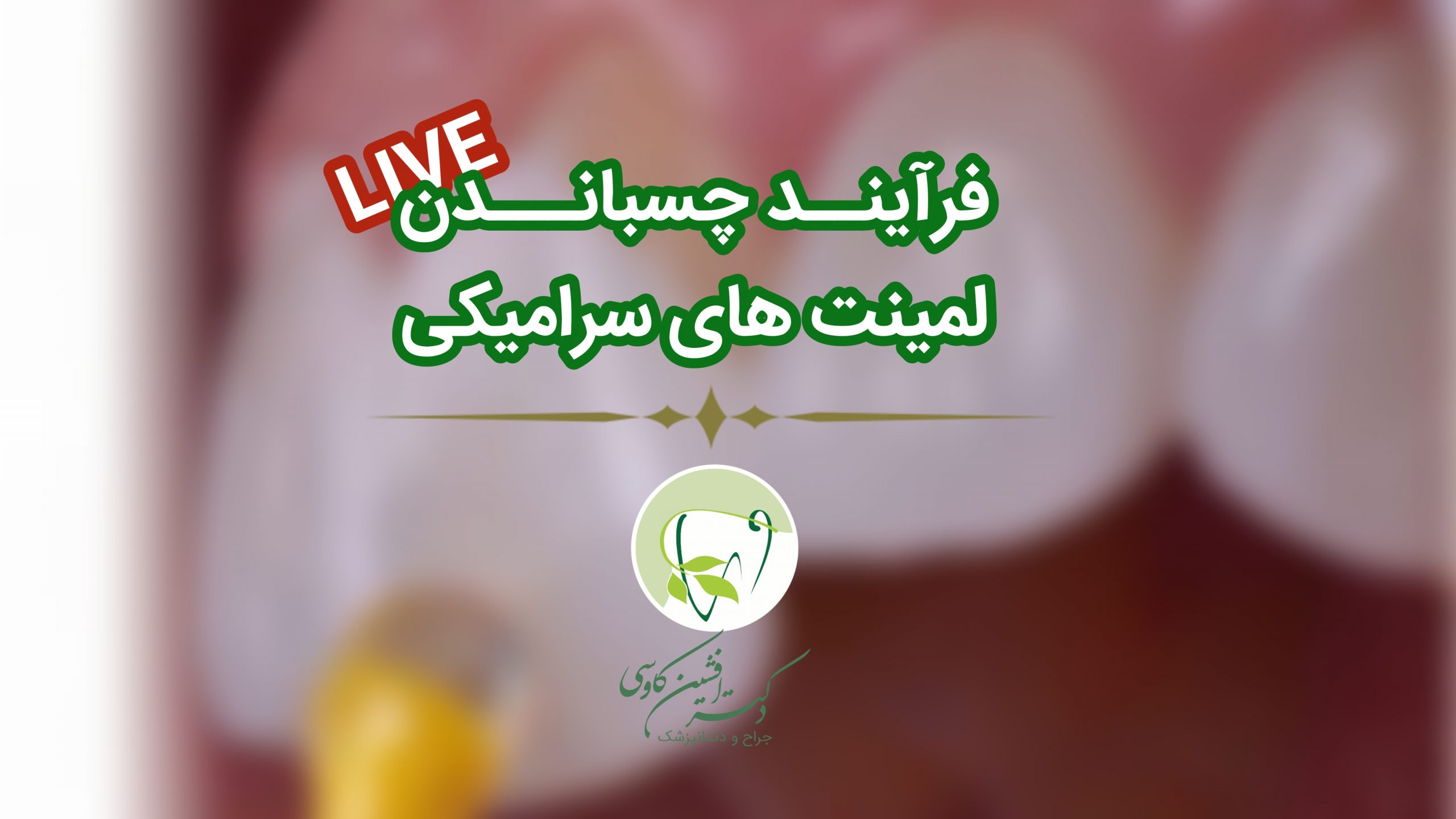 فرآیند چسباندن لمینت سرامیکی به دندان -وبسایت دکتر افشین کاوسی