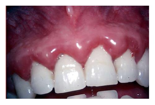 بیماری دیابت و مشکلات دندانپزشکی مرتبط با آن-مقالات وبسایت دکتر افشین کاوسی
