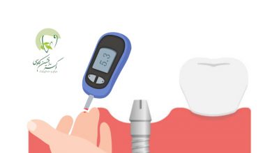 درمان ایمپلنت برای بیماران دیابتی-وبسایت دکتر افشین کاوسی