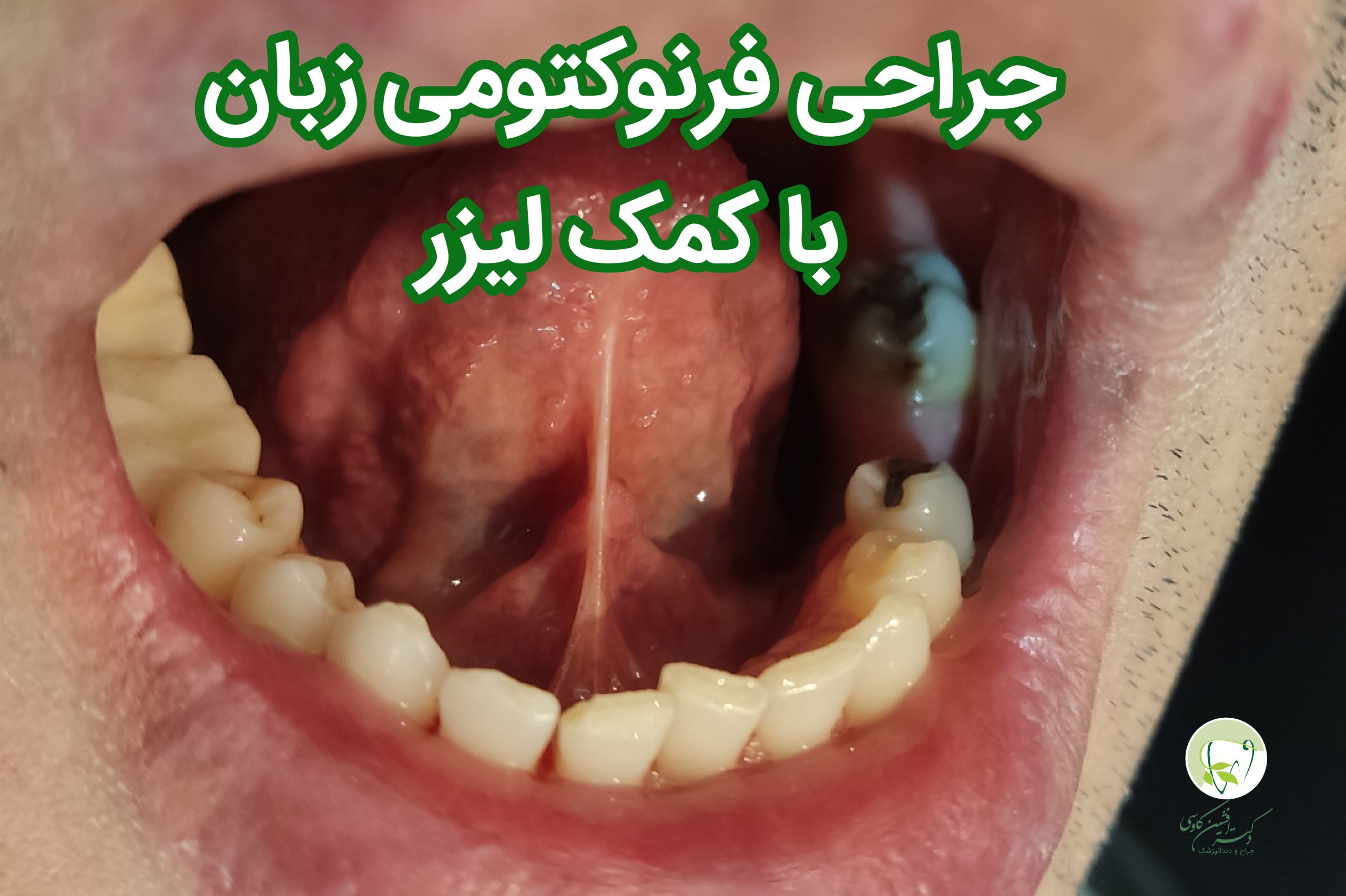 جراحی فرنوم زبان با لیزر- وبسایت دکتر افشین کاوسی