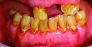 مشکلات دندانپزشکی در سالمندان -وبسایت دکتر افشین کاوسی