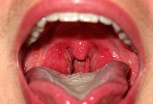 سکس دهانی ،از ابتلا به عفونتها تا سرطان گلو - وبسایت دکتر افشین کاوسی
