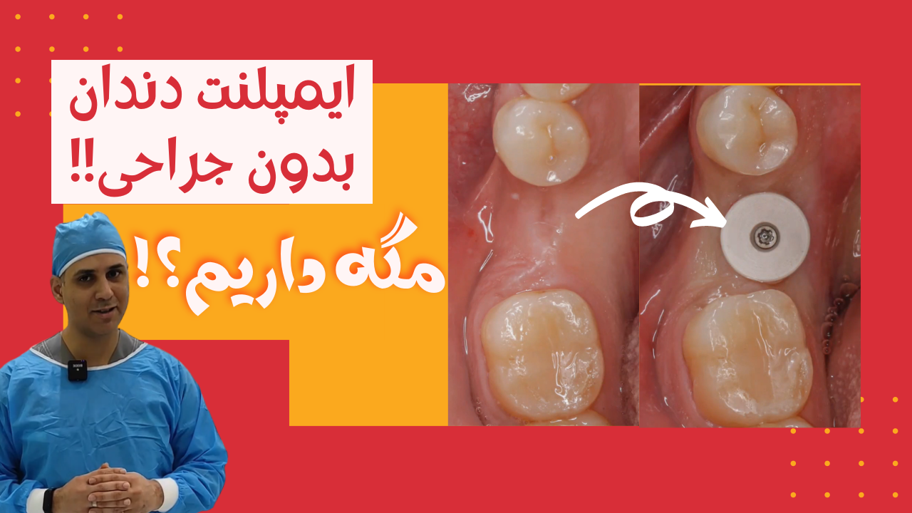 آیا انجام ایمپلنت دندان بدون جراحی ممکن است؟